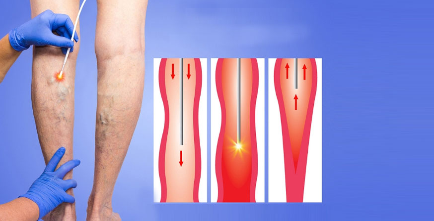 What Are the types of Noninvasive Treatments for Varicose Veins?