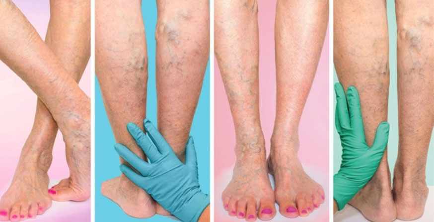 What should I do to prevent varicose veins from coming back