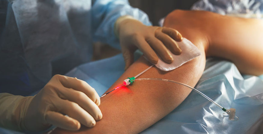 The Role of Compression Therapy in Varicose Vein Management: What