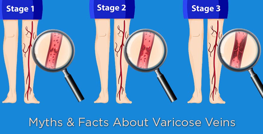 Facts and Myths related to Varicose Vein Disease