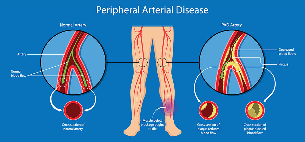 Peripheral Arterial Disease PAD Treatment Symptoms Causes