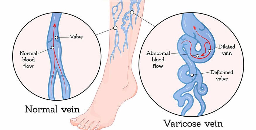 What are the Causes of Varicose Veins? - Flowcare