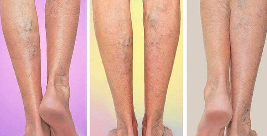 How To Prevent Varicose Veins?