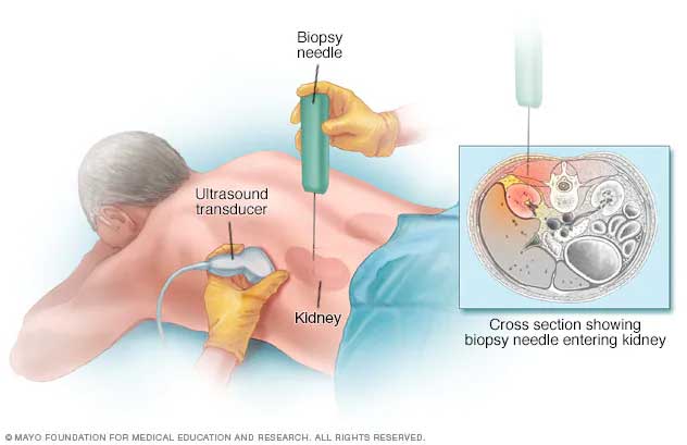 CT & Ultrasound Guided Biopsies