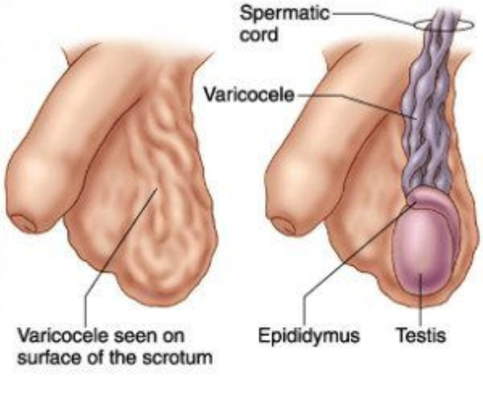 Home - : Symptoms, Treatment and Varicocele