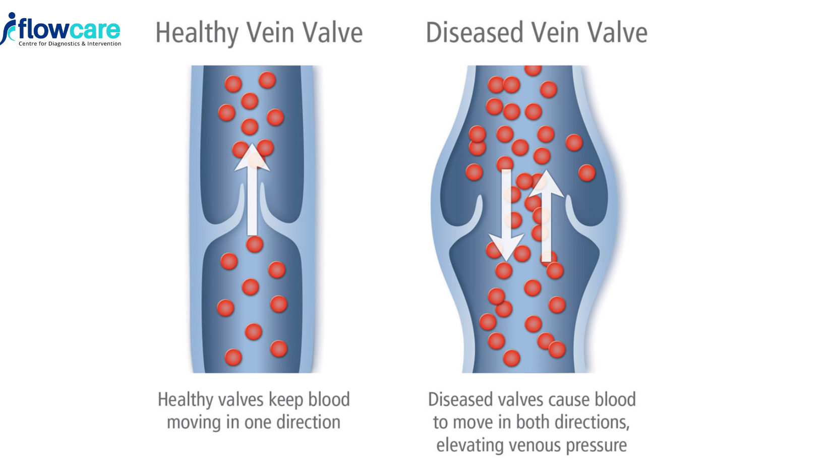 5 Tips to Prevent Varicose Veins Pain - Flowcare