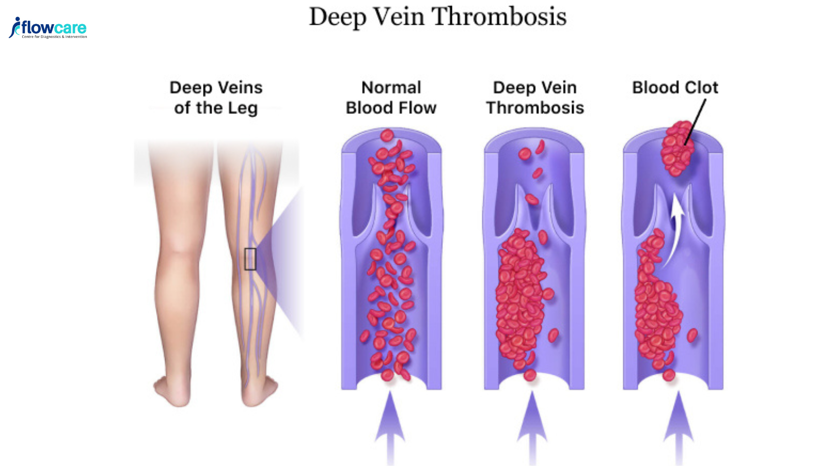 Deep Vein Thrombosis (DVT) vs. Varicose Veins: A Complete Guide