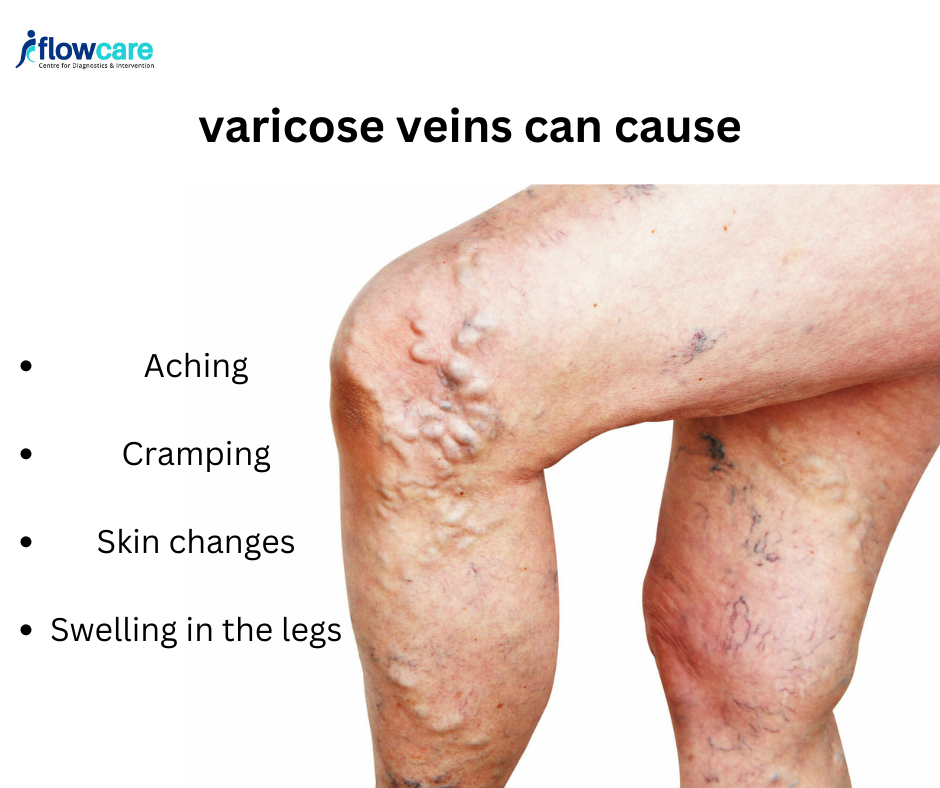 How to Prevent Varicose Veins: Lifestyle Changes and Habits