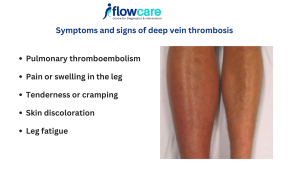 Symptoms and signs of deep vein thrombosis | Treatment