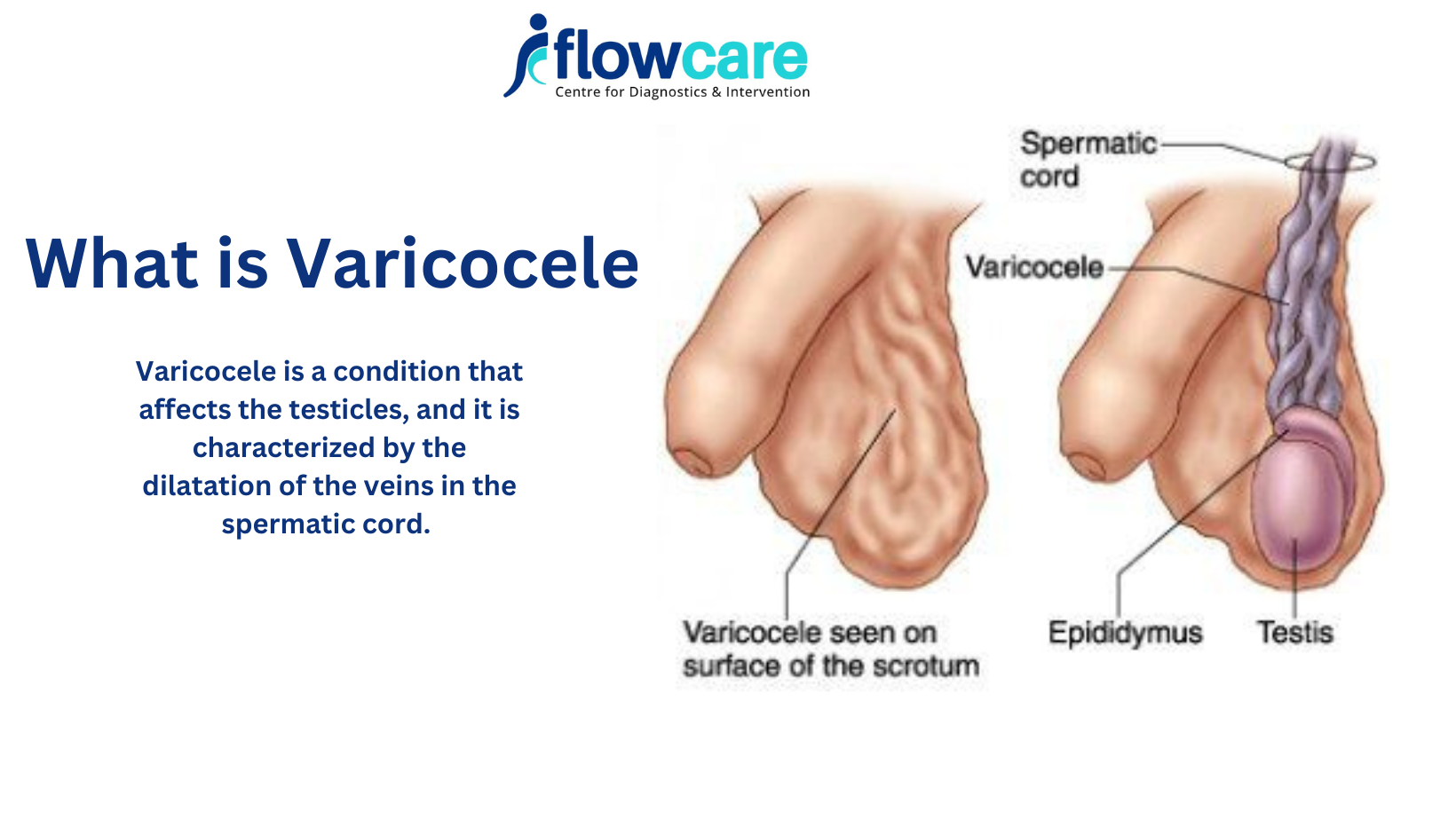 Varicocele treatment