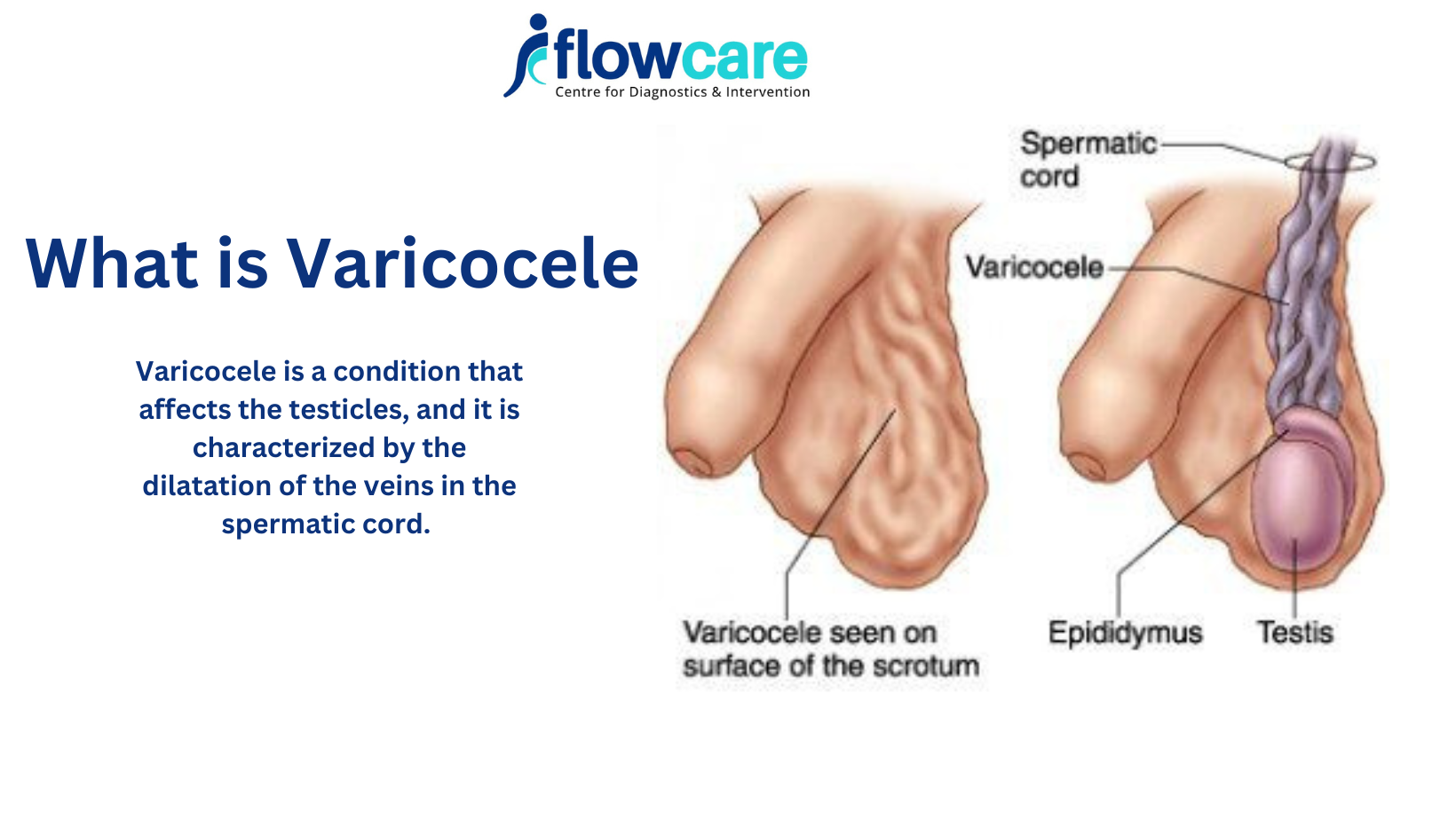 Non-surgical treatment for varicocele-embolization