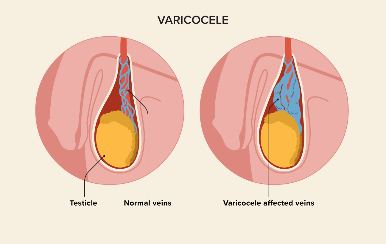 Micro varicocelectomy and Varicocele Embolization