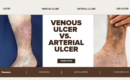 Venous Ulcers