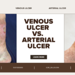 Venous Ulcers