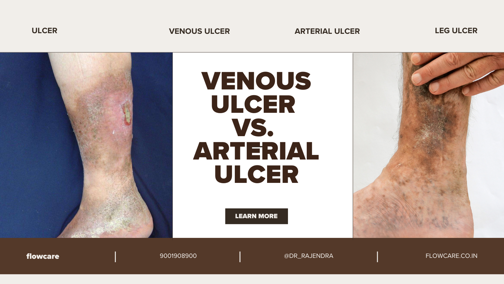 Venous Ulcers