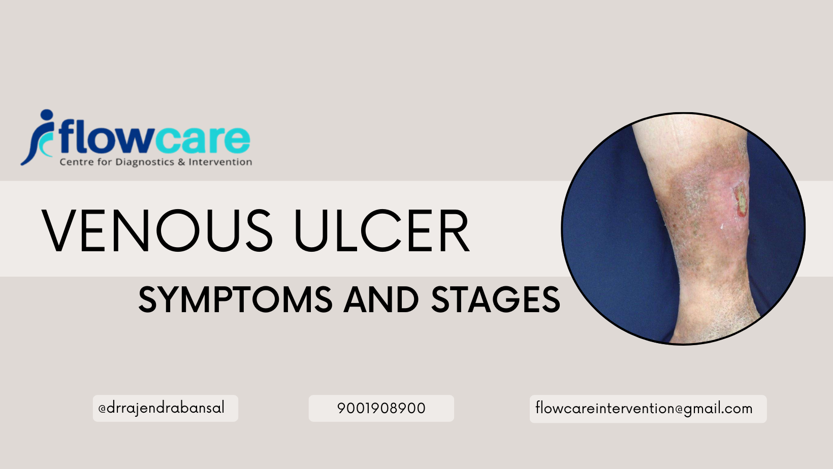 Venous Ulcer