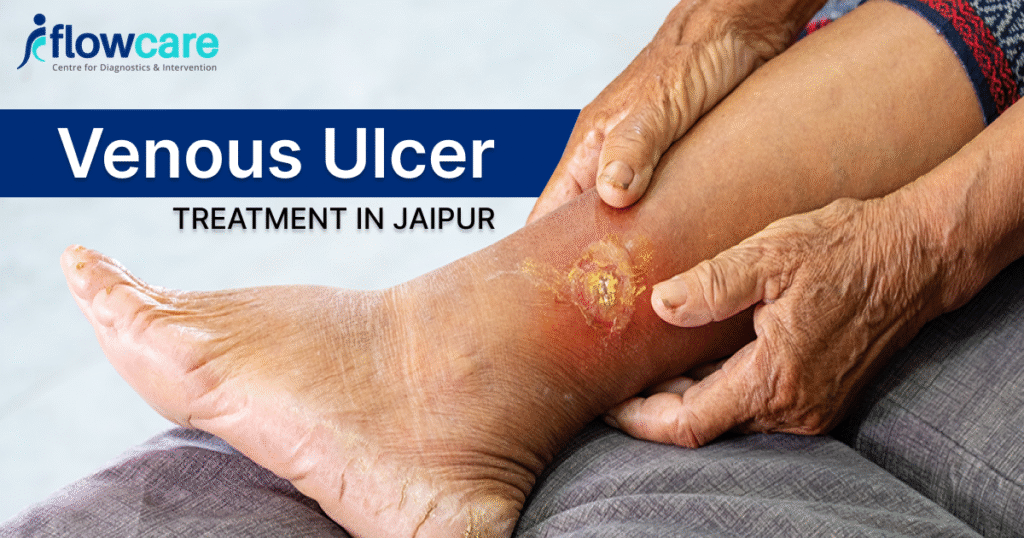 venous ulcer treatment in jaipur