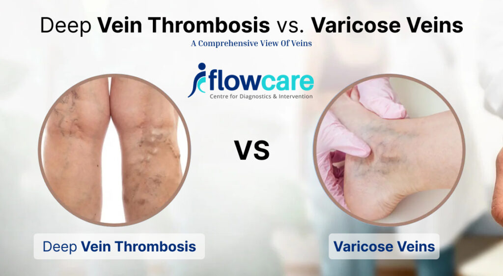 deep vein thrombosis vs. varicose veins