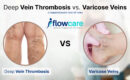 deep vein thrombosis vs. varicose veins