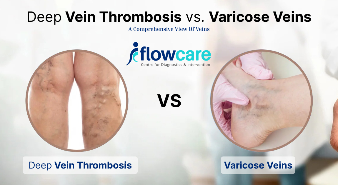 deep vein thrombosis vs. varicose veins