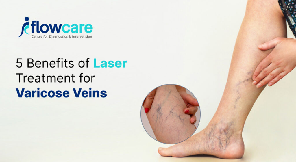 Laser Treatment for Varicose Veins