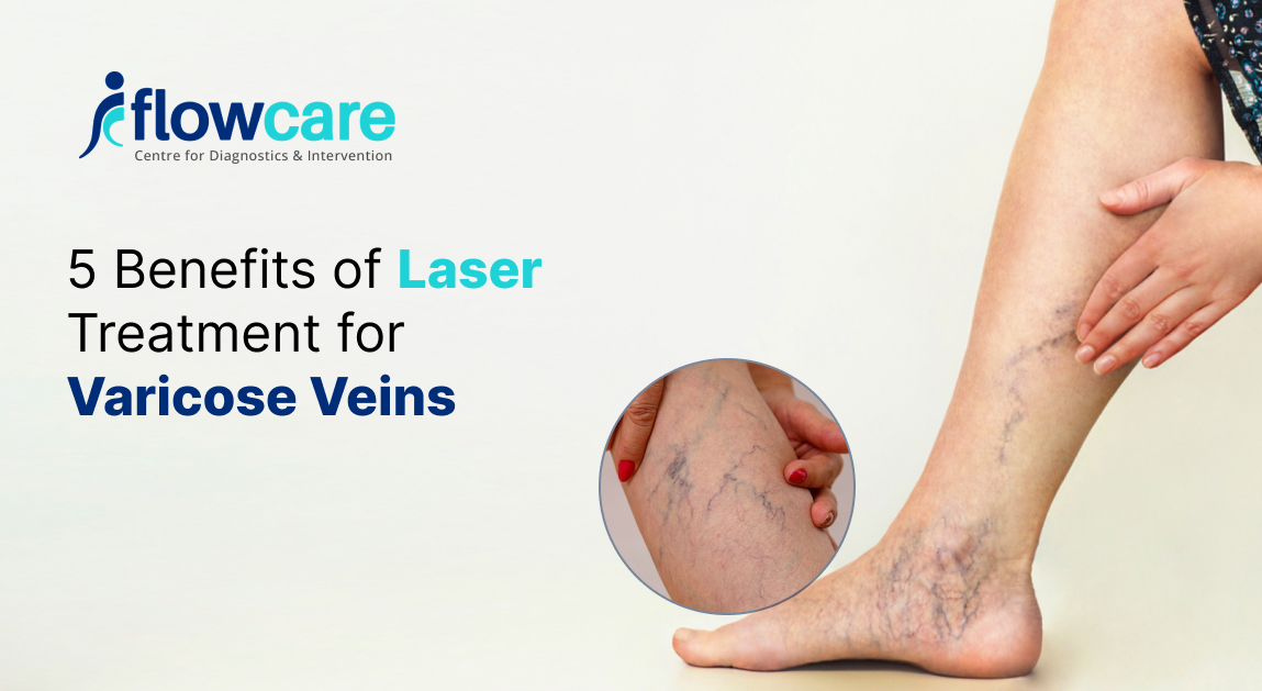 Laser Treatment for Varicose Veins