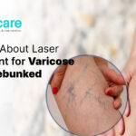 LASER TREATMENT FOR VARICOSE VEINS