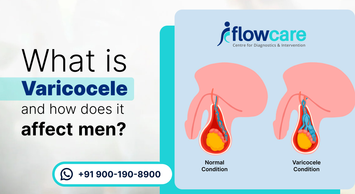 What is Varicocele and How Does It Affect Men