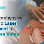 A Comprehensive Guide to Laser Treatment for Varicose Veins