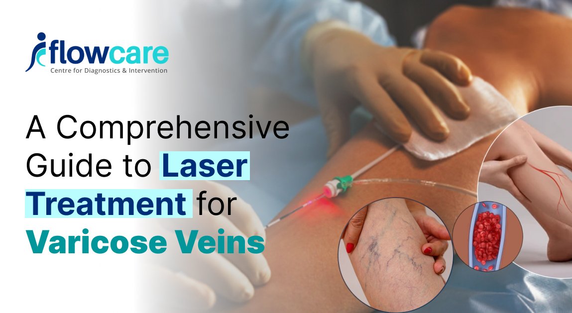 A Comprehensive Guide to Laser Treatment for Varicose Veins