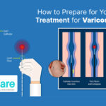 LASER TREATMENT FOR VARICOSE VEINS