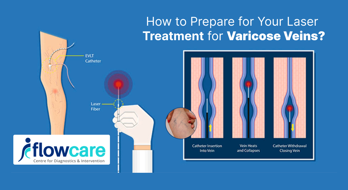 LASER TREATMENT FOR VARICOSE VEINS