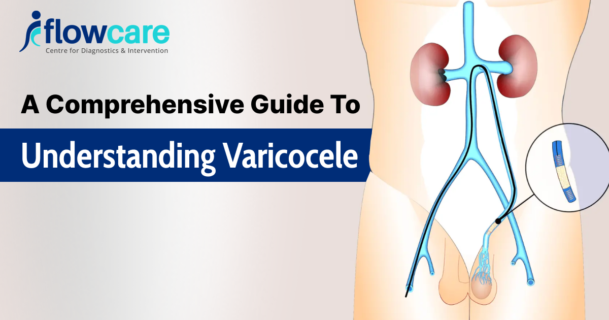 a comprehensive guide to understanding varicocele