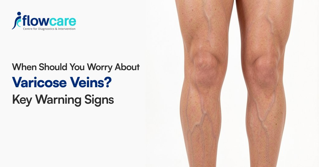 when to worry about varicose veins