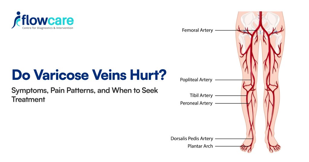 Do Varicose Veins Hurt