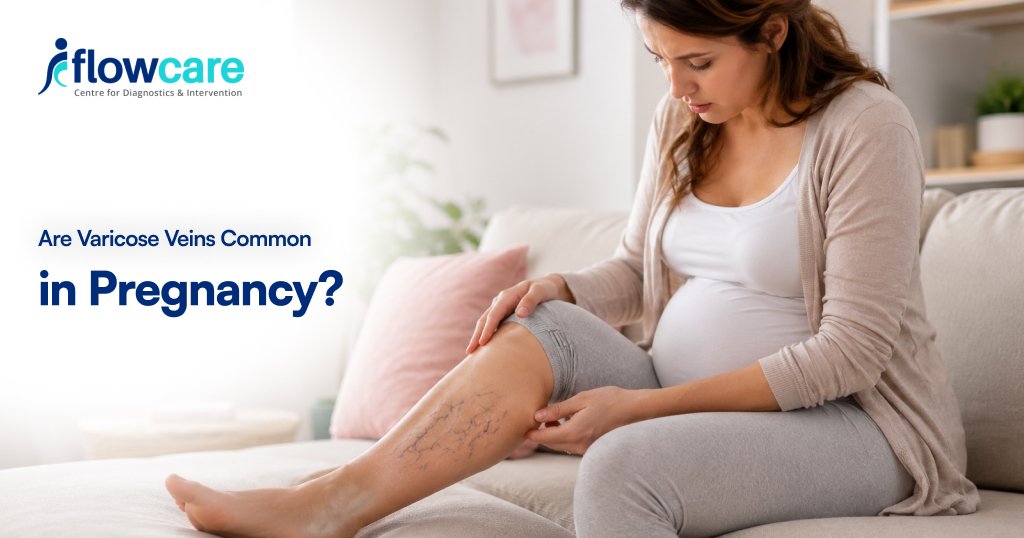 varicose veins pregnancy